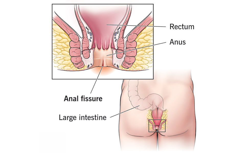 Cutting Edge Laser Treatment For Anal Fissures